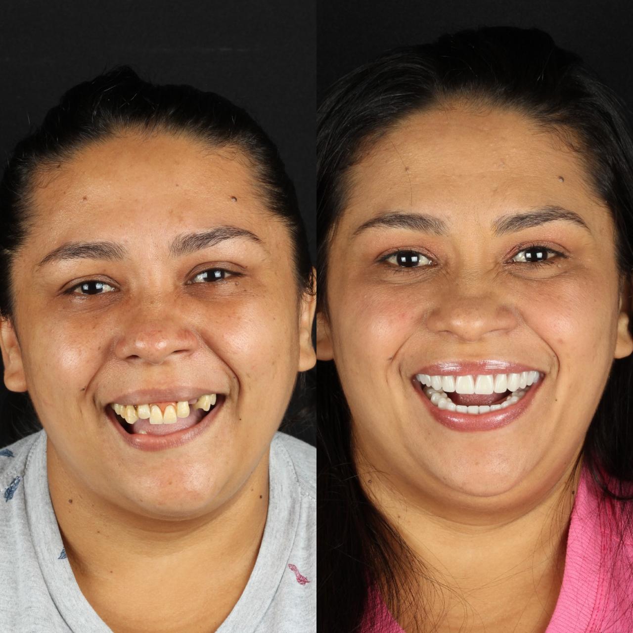 Antes e depois — paciente da Clínica Reabilitar